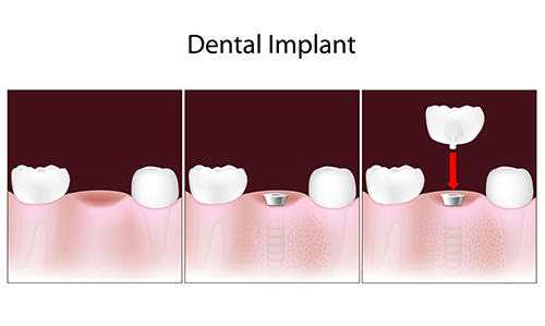 Hacienda Heights Dental Implants