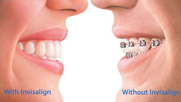 Invisalign Dentist Hacienda Heights